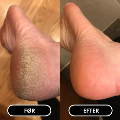 SilkFoot Relief Stick – Silkebløde fødder året rundt